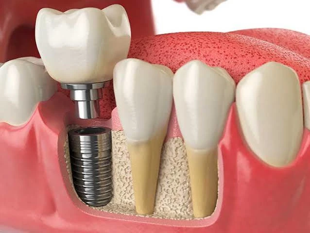 implantes